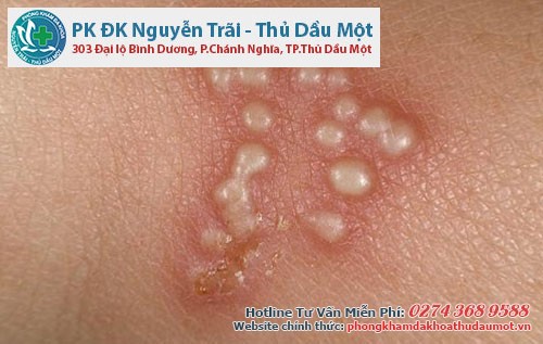 Mụn rộp gây ảnh hưởng không nhỏ