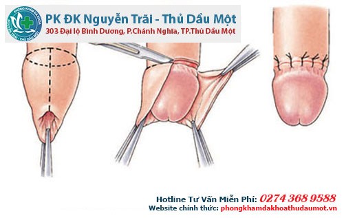 Ảnh hưởng khi cắt bao quy đầu có thể gây nhiều biến chứng xấu 