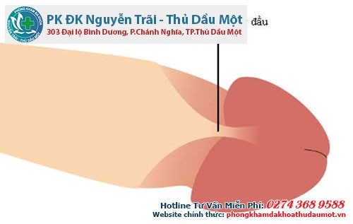 Dây hãm dương vật ở nam giới rất dễ bị đứt