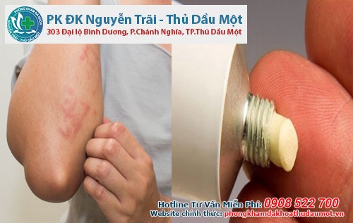 Một số loại thuốc mỡ được dùng để điều trị chứng ngứa chân