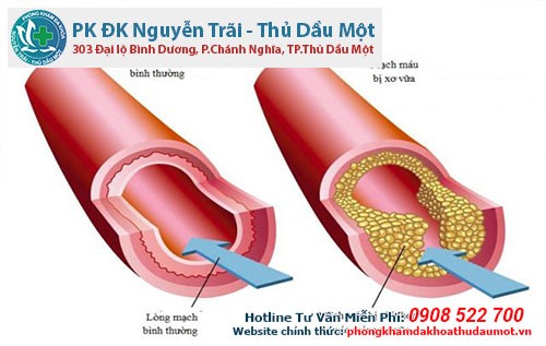 Xơ vữa động mạch